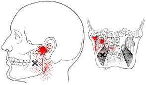 M. pterygoideus medialis